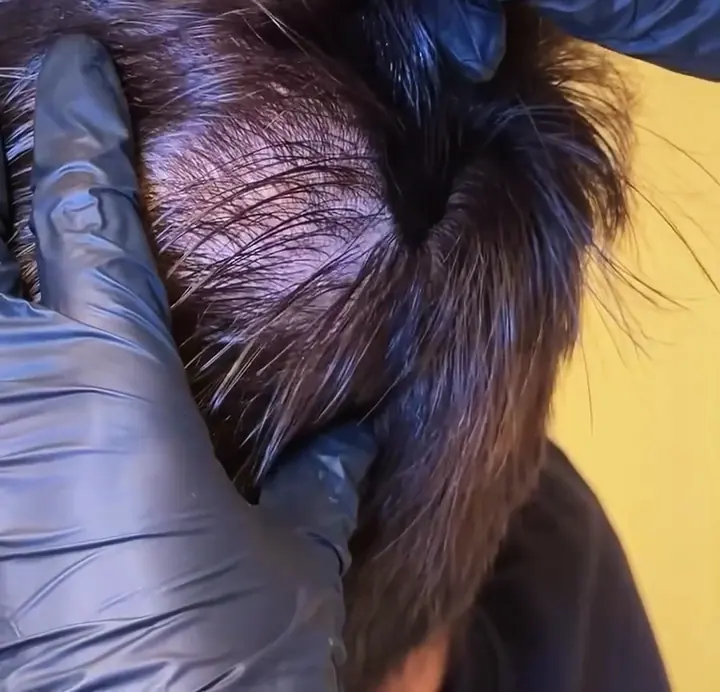 A scalp micropigmentation treatment in progress at the clinic, gloved hands working through dark hair.