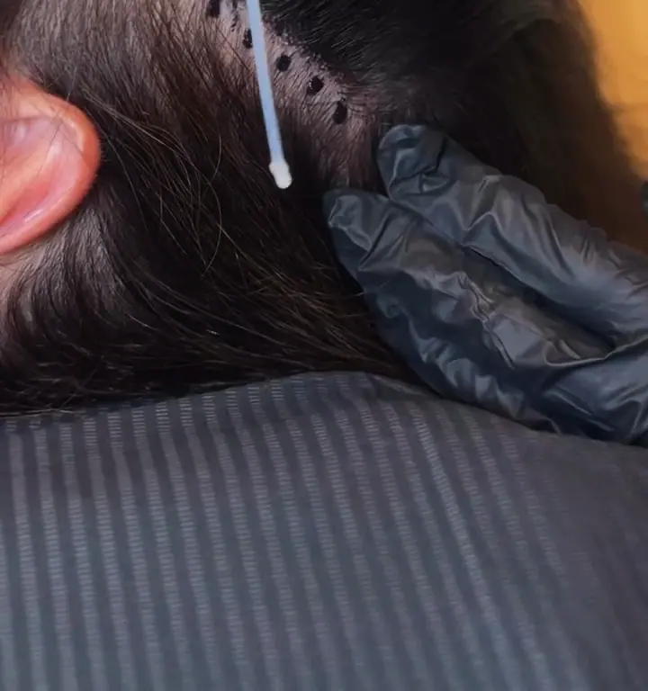 A close crop of the treatment device working across the scalp.